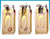 Endodoncia